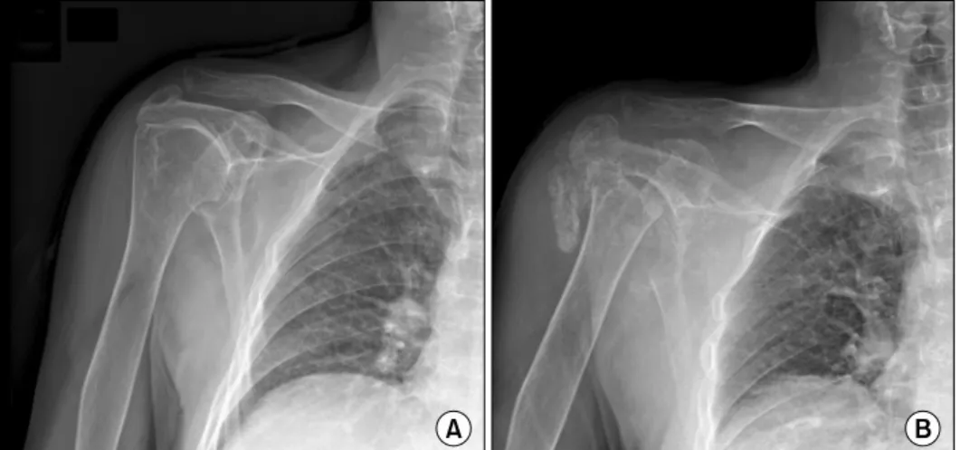 Figure 2.  Computed tomog- tomog-raphy shows complete  destruc-tion of the humeral head and  erosion of the glenoid.