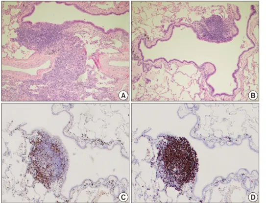 Figure 3. Pathology of lung bi- bi-opsy specimen. In hematoxylin  and eosin stained section,  peri-bronchiolar lymphoid  hyper-plasia with polymorphous  lym-phoid populations was  ob-served (A, ×100)