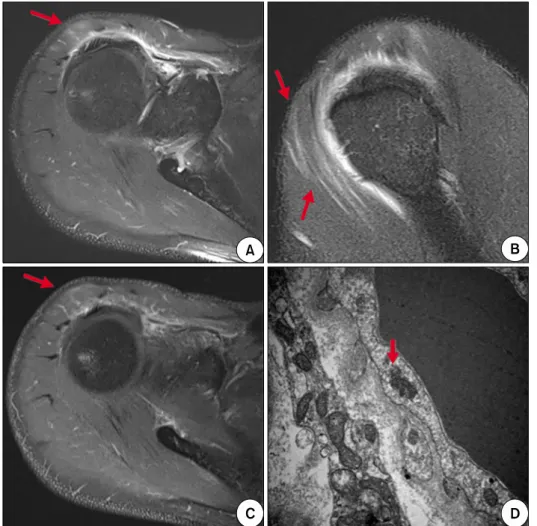 Figure 1. T2-weighted magnetic resonance images (A, B) and  en-hanced T1-weighted magnetic  resonance image (C) showed  high signal intensity in right  su-praspinatus and anterior deltoid muscles (arrows)