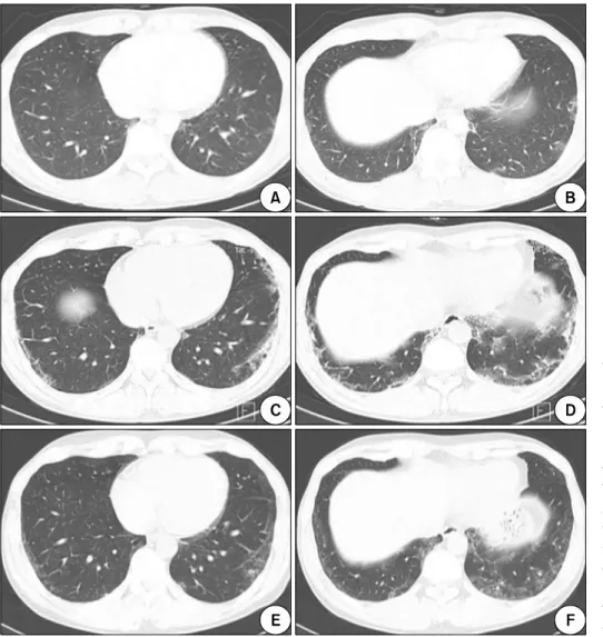 Figure 2. Initial chest computed tomography (CT) images showed  multifocal patchy ground glass  opacities (GGOs) in subpleural  portion of both lower lungs (A,  B)