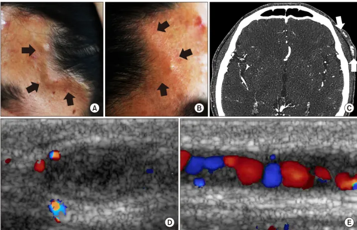 Figure 1. Gross appearance (A: left, B: right), computed tomographic angiography (C) and Doppler ultrasound images (D: short ax- ax-is, E: long axis) of the nodular lesion on the left superficial temporal artery.
