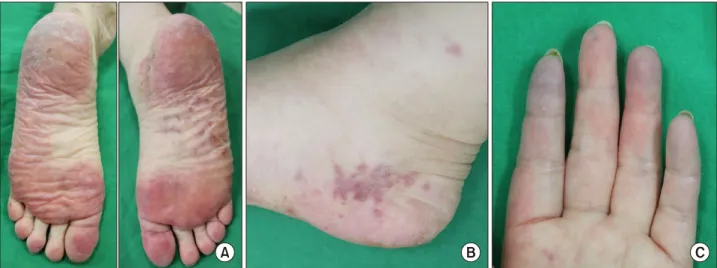 Figure 1. (A) Diffuse redness with mild swelling on the both sole. (B) Grouped bean sized violaceous macules on the medial side of right heel