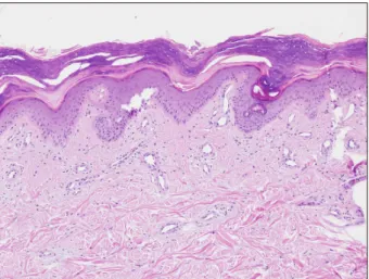 Figure 3. Scattered dilated vessels in the upper dermis (H&amp;E, 