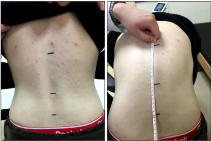 Figure 1.  Modified Schober’s test. With patient standing up- up-right, two points are marked on the back 5 cm below and 10  cm above the horizontal line joining the dimples of Venus  which is used as a mark for the lumbosacral junction