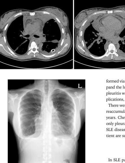 Figure 3.  Chest computed to- to-mography showing bilateral  pleural effusion with  multilo-culated effusion in both  hemi-thoraces.