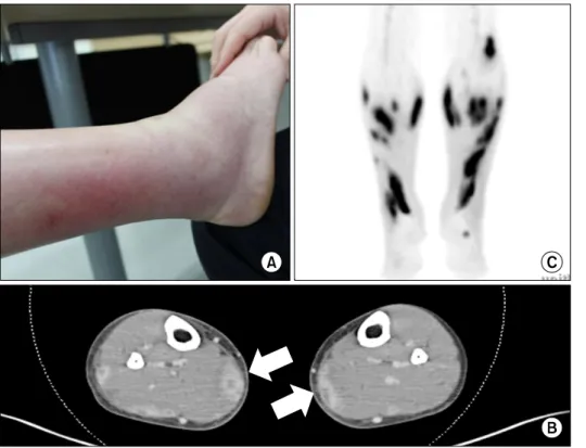 Figure 1. (A) Erythematous swel- swel-ling in the right lower leg and (B) computed tomographic scan  showed intramuscular central  low density and peripheral  en-hancement, and superficial  fas-cial thickening with  subcuta-neous fat edema (arrows) and (C)