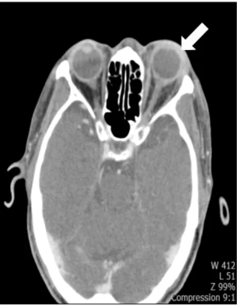 Figure 4. Orbital computed tomographic scan revealed swel- swel-ling and increased attenuation (arrow) of left periorbital soft  tissue.
