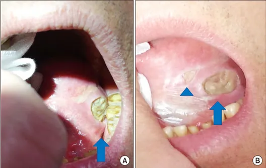 Figure 1. A 20×10 mm sized  oral ulcer (arrows) with deep  clean-cut margin on his left  bor-der of tongue (A), there was no  any improvement but small  ex-tra-ulcer (arrow head)  devel-oped during systemic steroid  therapy (B).
