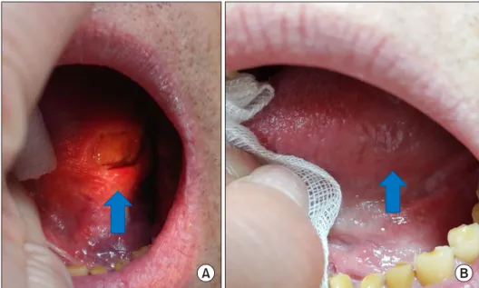 Figure 2. Healing ulcer (arrows)  at 2 months (A), and 7 months  (B) from administration of  adali-mumab.