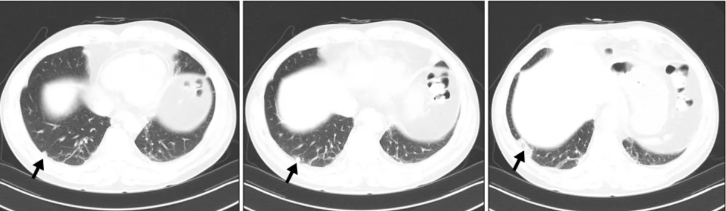 Figure 1. High-resolution computed tomography scan of the lungs reveals subpleural distribution of small hyperdense nodules  (black arrow) in the right lower lobe.