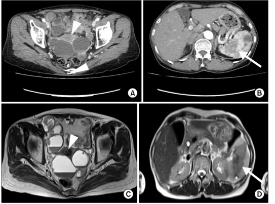 Figure 1. Abdominal computed  tomography (CT; A, B) and  mag-netic resonance imaging (MRI; 