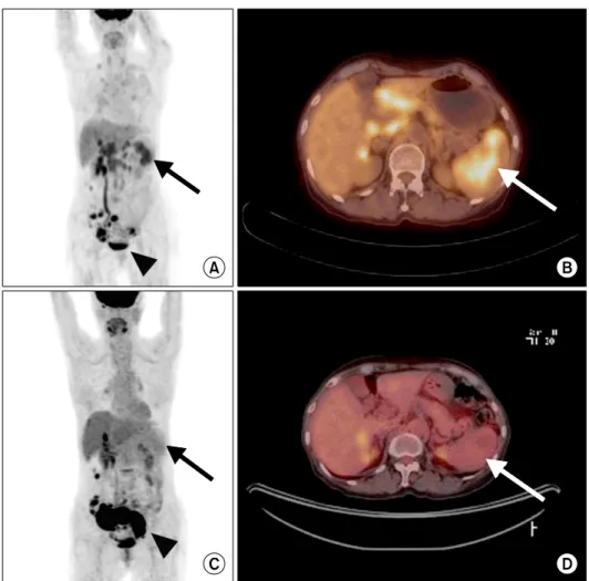 Figure 2.  18 F- fluorodeoxyglucose (FDG) labeled  positron-emi-ssion tomography before (A and B) and 1 month after (C and D)  prednisolone therapy