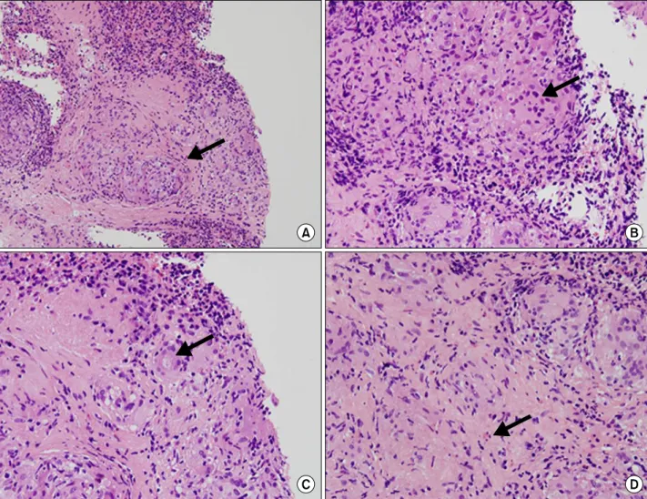 Figure 3. Microscopic findings in the spleen (hematoxylin and eosin staining). Noncaseating granulomas with aggregations of in- in-flammatory cells (arrow in A), multinucleated giant cells (arrow in B), asteroid body (arrow in C), and eosinophils (arrow in