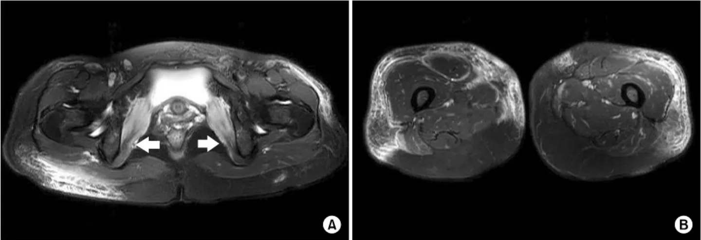 Figure 1. (A) Axial T2 weighted image with fat saturation showed bilateral symmetrical diffuse increased signal intensity in both obturator internus muscles (arrows)