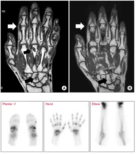 Figure 3.  Whole body bone  scintigraphy at first visit. Both  wrists, proximal interphalanges,  distal interphalanges, and  meta-carpophalanges joints on hands showed increased symmetric  uptake and tarsometatarsal  jo-ints and metatarsophalangeal  joins 