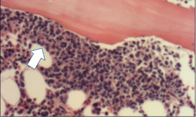 Figure 4. Bone marrow biopsy showed multiple lymphocytes concentrated with the various features