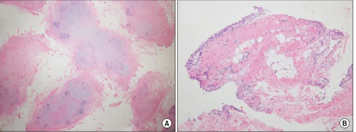 Figure 3.  Pathology of rice body and synovium. (A) Microscopic examination (H&amp;E, x40) revealed multiple nodular fi- fi-brocartilaginous tissues consistent with rice bodies