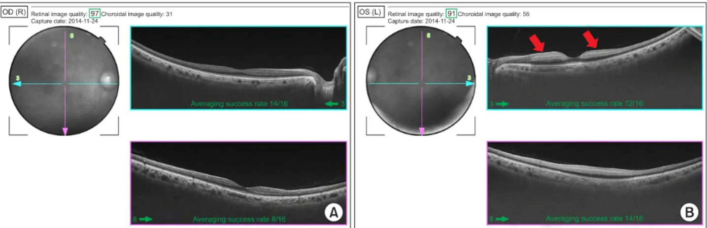Figure 3. Optical coherence tomography (OCT) shows cross-section images of retina. (A) OCT of the right eye shows normal  appearance