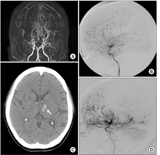 Figure 1. (A) Initial brain mag- mag-netic resonance angiography  shows stenosis of bilateral distal internal carotid arteries with  well-developed basal and pial  collaterals