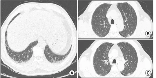 Figure 1. The chest radiograph revealed linear densities and  small nodules bilaterally in the lower lung fields