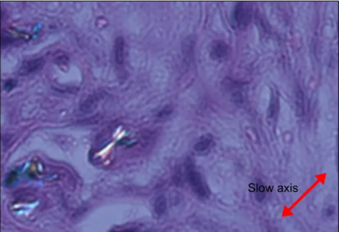 Figure 4. Polarized microscopic image showed negative bi- bi-refrigent needle-shaped crystals (H&amp;E, ×400).