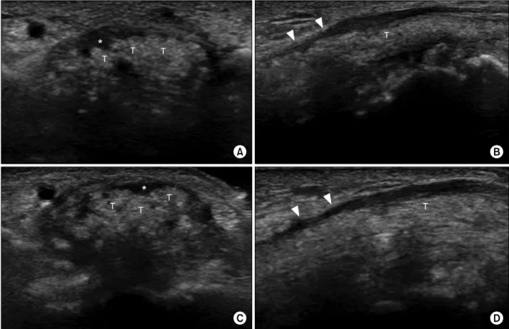 Figure 2. Ultrasonography shows increased cross sectional area of median nerve at the proximal carpal tunnel (*), tophaceous dep- dep-ositions of flexor digitorum tendons (T) with heterogenous hyperechogenicity, and compression of medial nerve at the dista