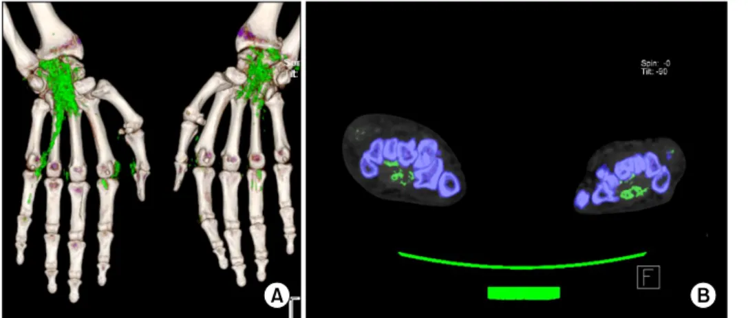 Figure 3. Dual-energy computed  tomography of upper extremity  shows diffuse multifocal green  color coding tophaceous  deposi-tions of both flexor digitorum  tendons, flexor pollicis longus  tendons, transverse carpal  liga-ment, metacarpophalangeal joint