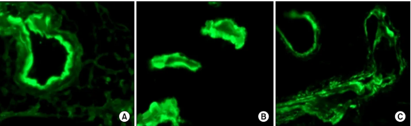 Figure 3. A full-house pattern immune-complex deposits in vessel wall including (A) immunoglobulin G (×400), (B) im- im-munoglobulin M (×400), and (C) C1q, by immunofluoresence microscopy (×400).