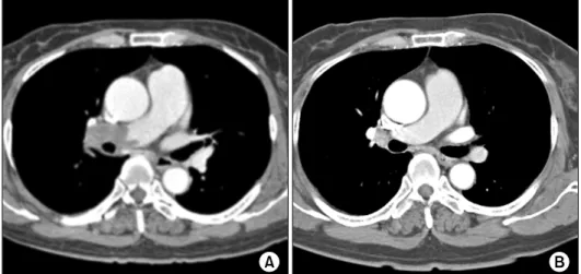 Figure 1. Spiral chest computed  tomography showing pulmonary thromboembolism in the right  pulmonary artery (A) and chest  computed tomography showing  the absence of remarkable  re-sidual thromboembolism (B).
