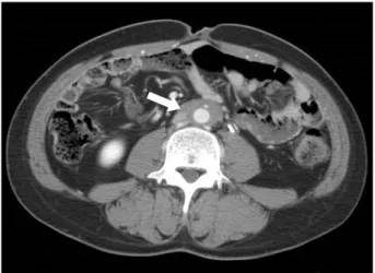 Figure 3. The retroperitoneal mass was decreased at the fol- fol-low-up abdominal computed tomography (arrow).