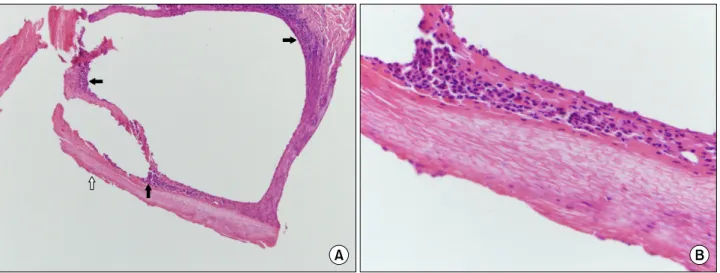Figure 4. Increased uptake at both ulnocarpal joint at a 31-year-old female patient (A), normal wrist x-ray (B).