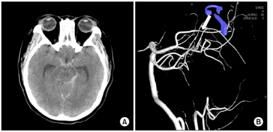 Figure 2.  This chest computed tomography shows diffuse  ground glass opacity, interlobular septal thickening