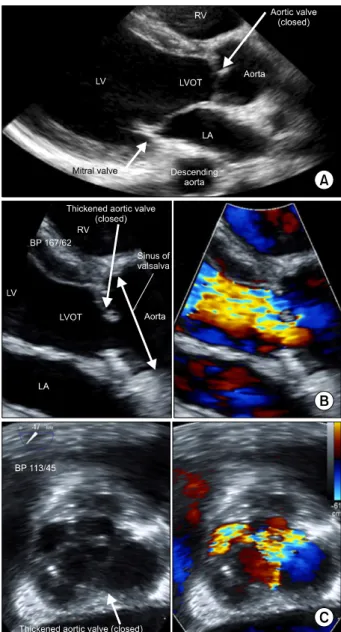 Figure 1. (A) Parasternal long axis view of transthoracic echo- echo-cardiography showed slightly thickened aortic valve and  mod-erately thickened aortic root