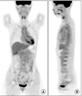 Figure 2. Positron emission tomography/computed tomog- tomog-raphy shows significant increased in 18-fluorodeoxyglucose uptakes along the walls of aortic valve, ascending aorta, aortic arch, descending thoracic aorta, and abdominal aorta, that  were sugges
