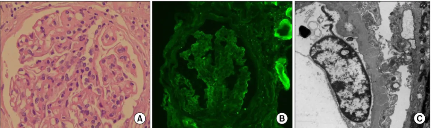 Figure 1. (A) Glomeruli sclerosis of 23.1% involves mesangial cells and endothelial cells (H&amp;E, ×400)