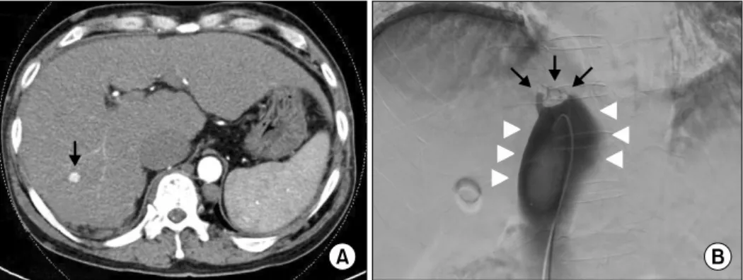 Figure 2. (A) Axial dynamic-enhanced computed tomography (CT) scan. On an arterial-enhanced CT image, a small enhancing  nodule was seen in right lobe of the liver (segment 7) measuring approximately 12 mm in diameter (arrow)