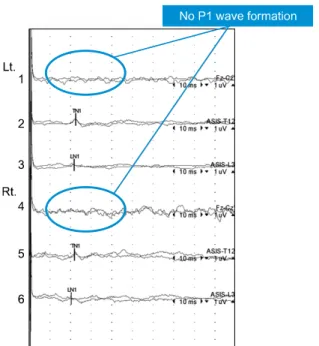 Figure 1. Posterior tibial nerve somatosensory evoked poten- poten-tial of the patient showed normal absolute latencies in both  TN1, LN1, but P1 wave was absent on both sides, which  in-dicates central conduction defect of the thoracic spinal cord