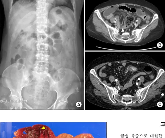 Figure 1.  (A) Plain radiograph  of abdomen shows gaseous  bowel distention. (B) Computed  tomography (CT) of abdomen  shows small bowel obstruction  with marked dilatation, focal  enhancing soft-tissue density  in-filtration of mesentery with small ascite