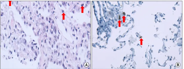Figure 2.  Chest computed tomography with coronal re- re-formatted image shows a large cavitary mass like lesion in the  right upper lobe.