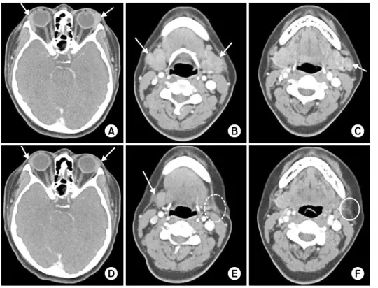 Figure 1.  Comparison of radio- radio-logical features before and after  excisional biopsy of the left  sub-mandibular gland and left  cer-vical lymph node and medical  treatment