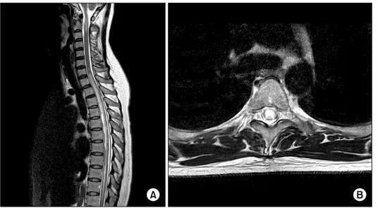 Figure 1. Spinal  MRI  of  the  patient  with  neuromyelitis  optica  (T2  weighted  imaging)