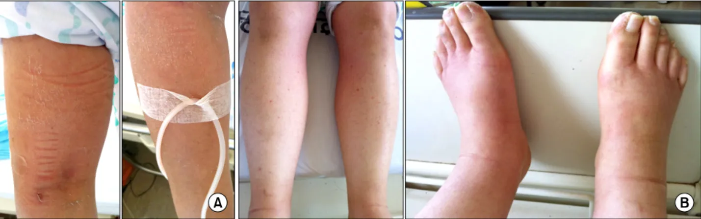 Figure 1. Gross  appearance  of  generalized  edema  of  upper  (A)  and  lower  extremities  (B)  in  a  47-year-old  woman  with  acute  polymyositis.