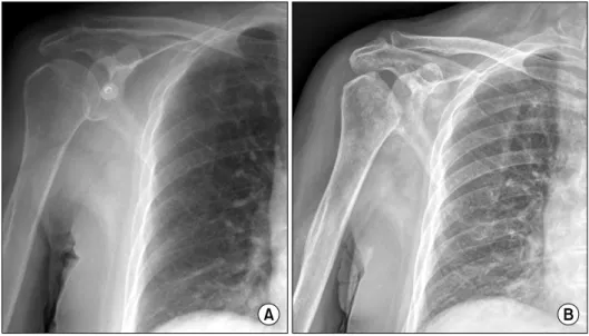 Figure 1. Radiograph  of  the  right  shoulder.  (A)  Radiograph  of  the  right  shoulder  before  cerebral   an-giography  shows  normal  humeral  head
