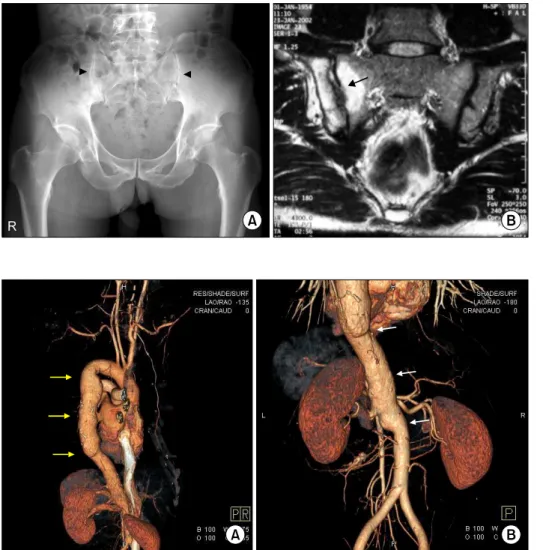Figure 2. Incidentally  detected  aortic  aneurysm.  (A)  Chest   com-puted  tomographic  imaging  of  three-dimensional  reconstruction  shows  a  dilated  descending  aorta  (yellow  arrows)