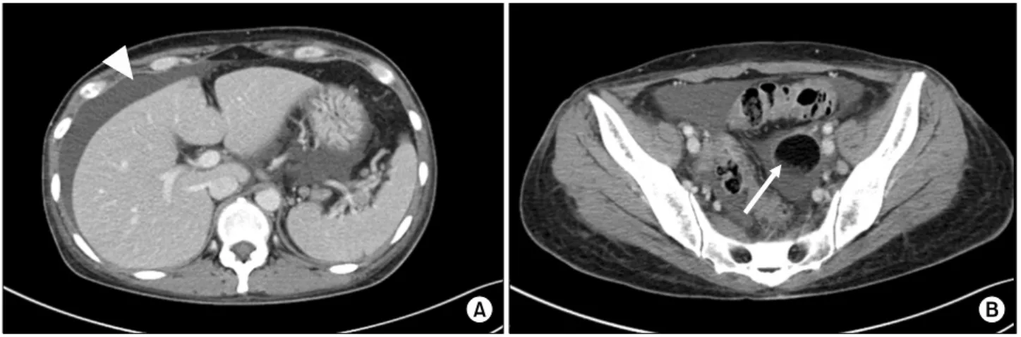 Figure 2. Abdominal  computed  tomography  showing  ascites  (arrowhead  in  A)  and  4.3  cm  sized  ovarian  tumor  (arrow  in  B)