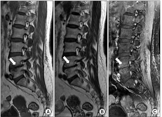 Figure 21. Abnormal  intervertebral  disc:  Modic  type  I  change.  (A)   Sagi-ttal  T1-weighted,  (B)  T2-weighted  and  (C)  fat-suppressed  Gd-enhanced  T1-weighted  MR  images  show  marrow  edema  and  inflammation  without  erosion  around  L4-5   i