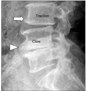 Figure 19. Segmental  instability  of  lumbar  spine.  A  traction  osteophyte  (arrow)  in  L3  body  develops  2  to  3mm  from  the  edge  of  the  intervertebral  disc  and  horizontal  direction