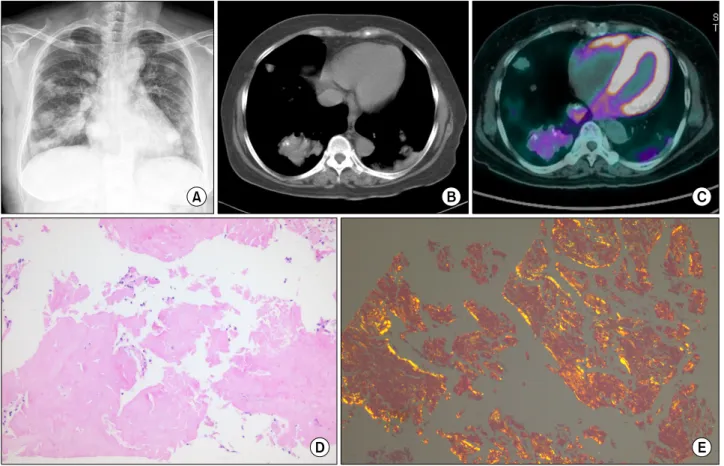 Figure 1. Multiple  nodules  and  a  mass  in  both  lung  field.  Histology  showing  dense  accumulation  of  typical  amorphous  eosinophilic  material  and  calcification,  and  Congo  red  stain  showed  apple-green  birefringence.