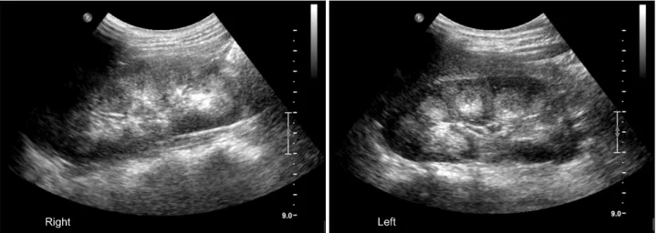 Figure 1. Kidney  ultrasonography  reveals  diffuse  increased  echogenecity  of  medulla  of  both  kidneys,  suggesting  medullary  nephrocalcinosis