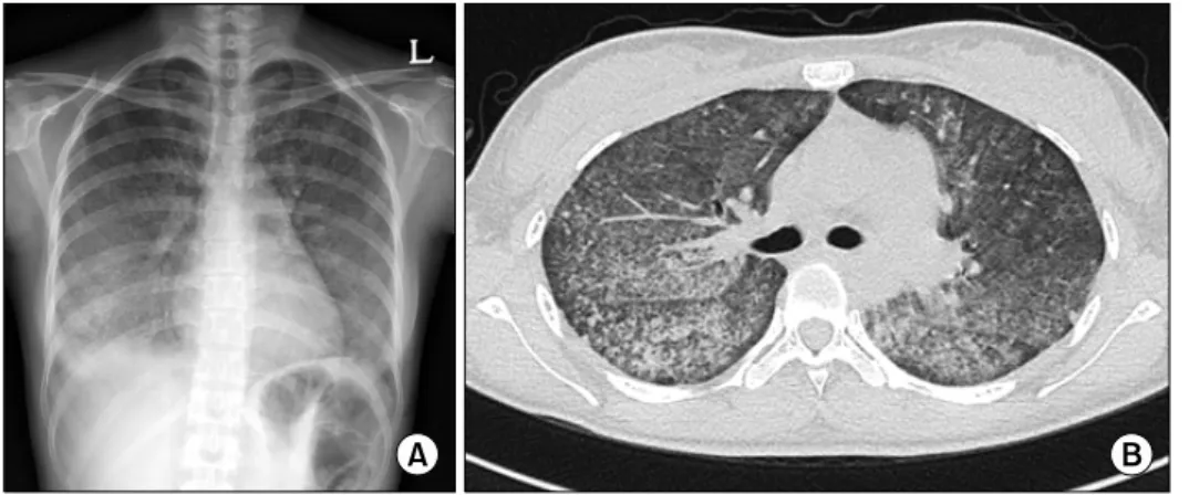 Figure 1. The  initial  radiologic  findings.  (A)  Chest  radiograph  showed  bilateral  diffuse  ground  glass  opacity